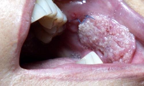 Рак полости рта: начальная стадия