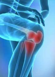 mi a káros a térdízület artrózisában könyökideg betegség